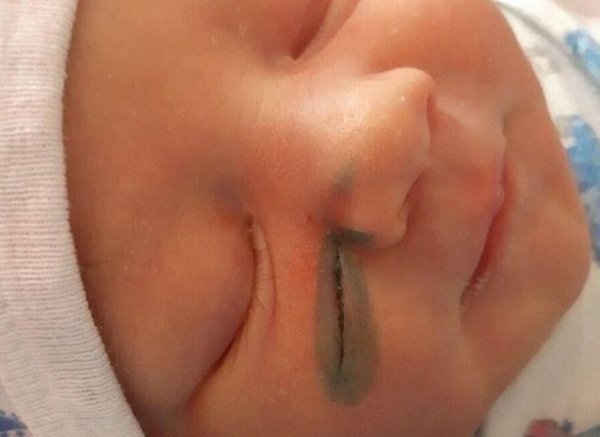 Rusya'da doktorlar doğum sırasında bebeğin yüzünü kesti